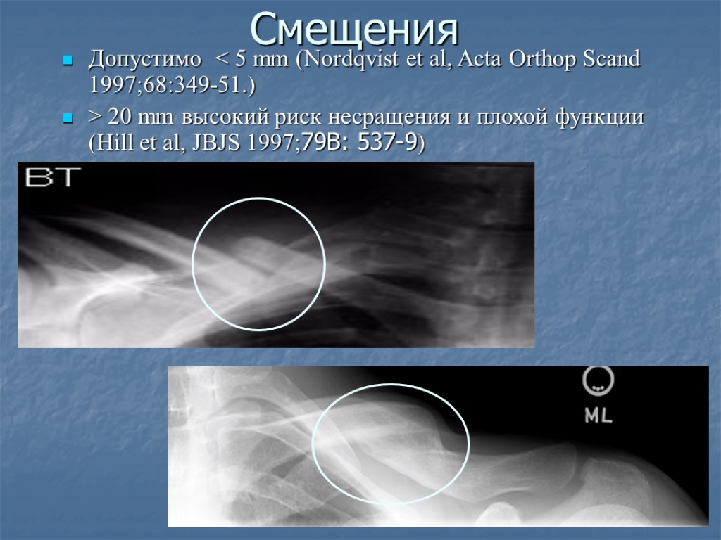 Смещения Допустимо < 5 mm (Nordqvist et al, Acta Orthop Scand 1997;68:349-51.) > 20